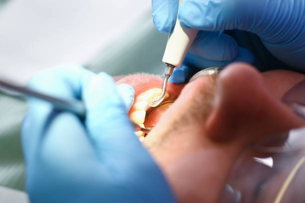 Best Chipped Tooth Repair Near Me  in Macom, IL